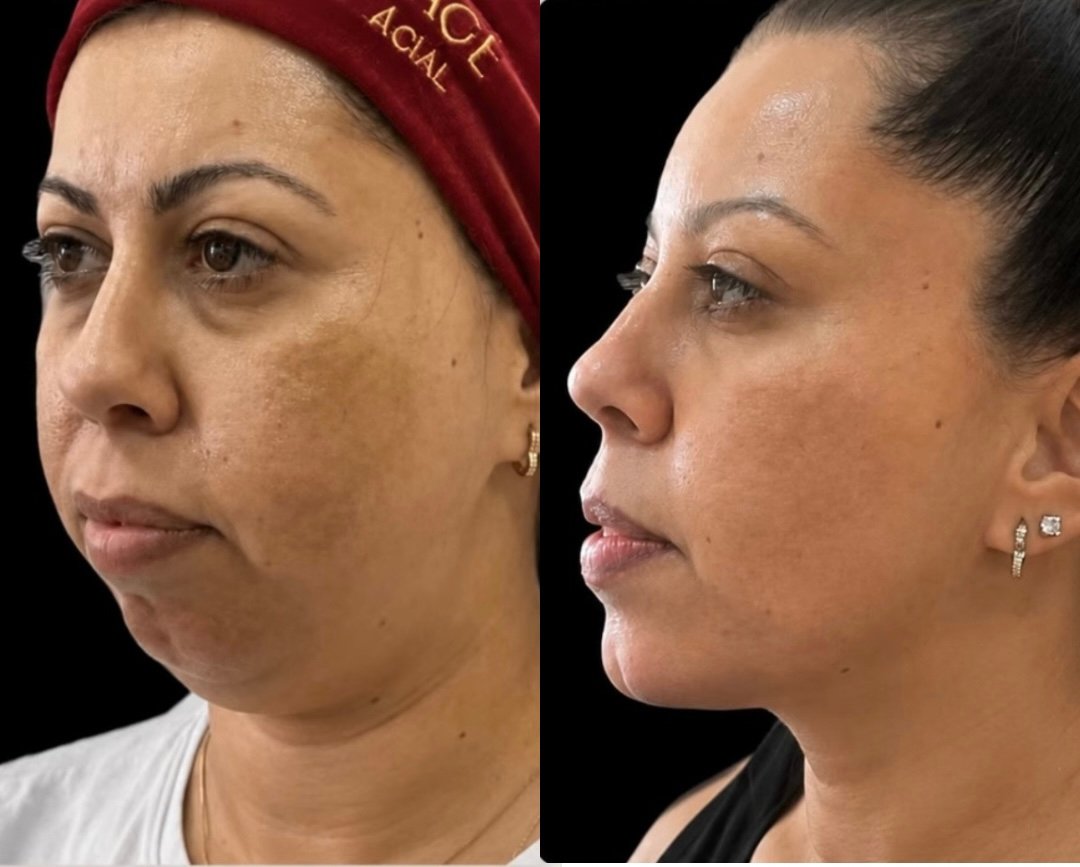 Comparativo de antes e depois de contorno e volume facial