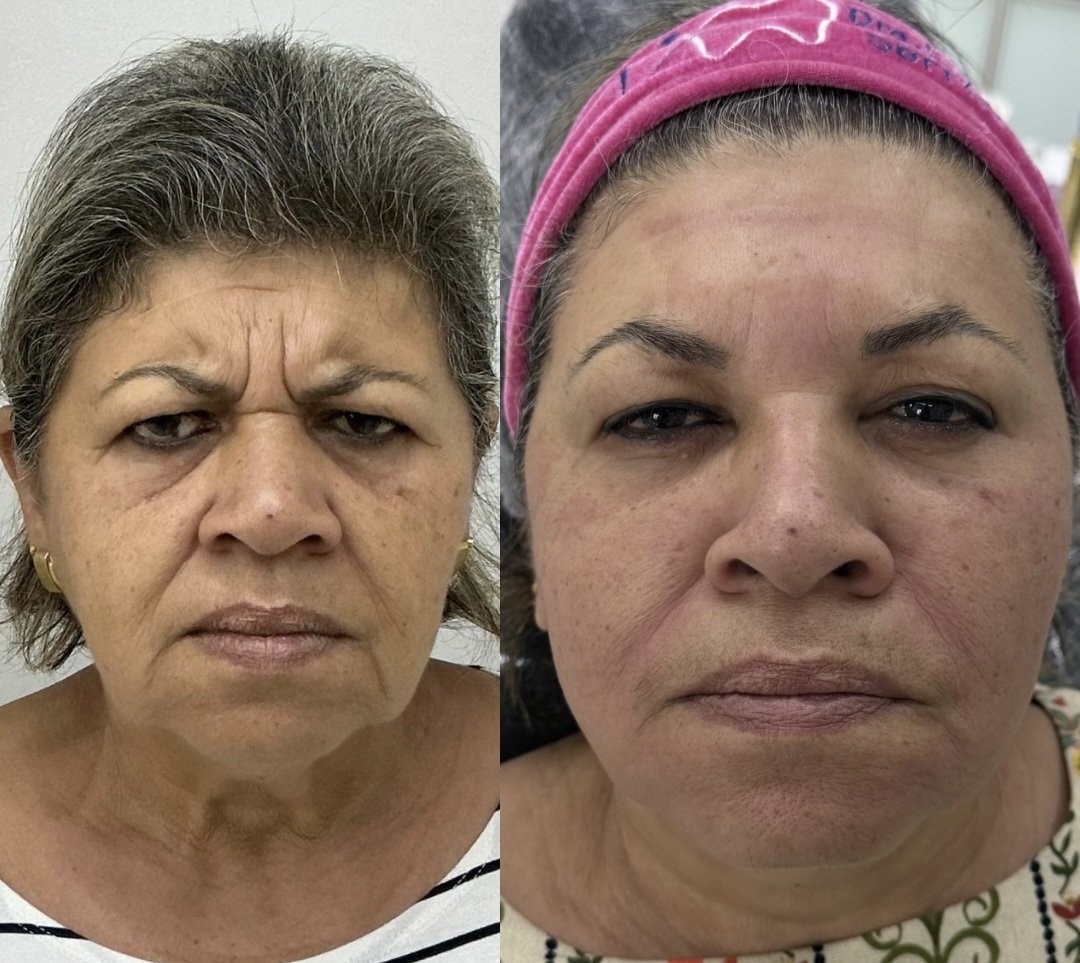 Comparativo lado a lado de paciente madura, caso 3